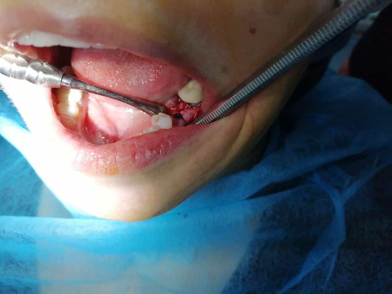 Implant Bredent - Caz 5