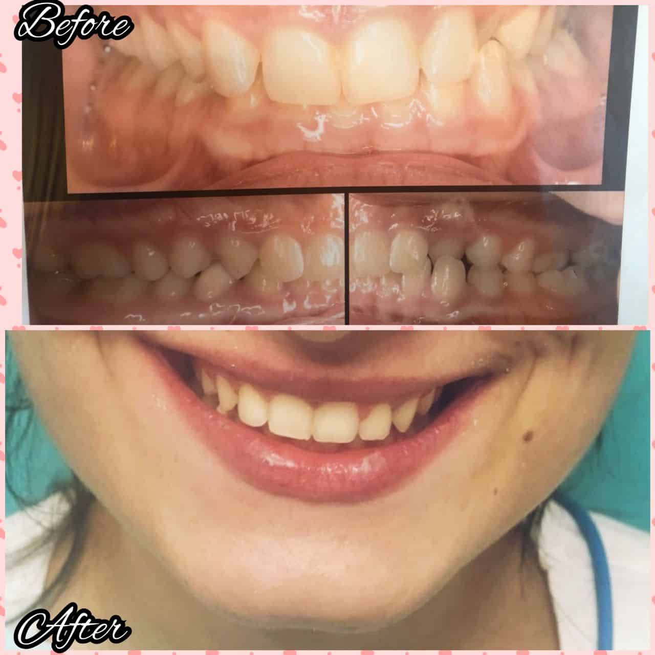 Rezultat ortodonție 6