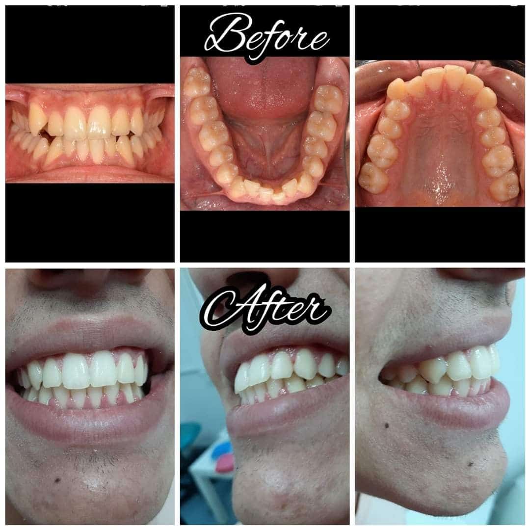 Smile deficiency barrier Tipuri de aparate dentare - Ortodontie DentalClinica